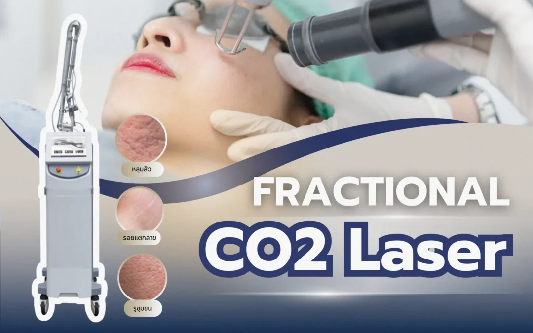 รักษาหลุมสิว ด้วย Fractional CO2 Laser