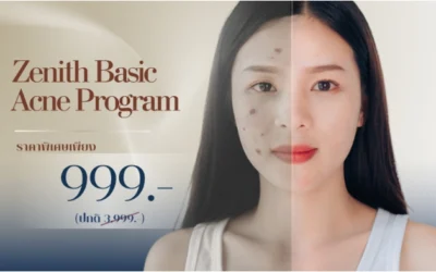 ทรีทเมนต์รักษาสิว Zenith Basic Acne Program : 5 ขั้นตอนสู่ผิวใสไร้สิว