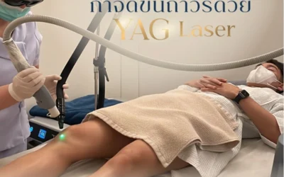 เลเซอร์กำจัดขน Long-Pulsed Nd YAG – เลเซอร์ตัวช่วยกำจัดขนถาวร